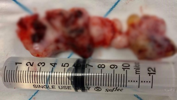 Cậu bé 14 tuổi mũi bị hủy vì u sợi mạch vòm mũi họng dài 12cm