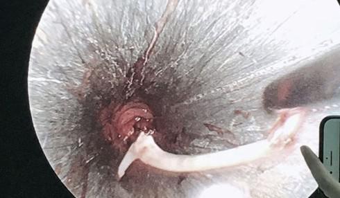 Người đàn ông ở Nghệ An suýt mất mạng vì chữa hóc xương cá bằng "nước thần"