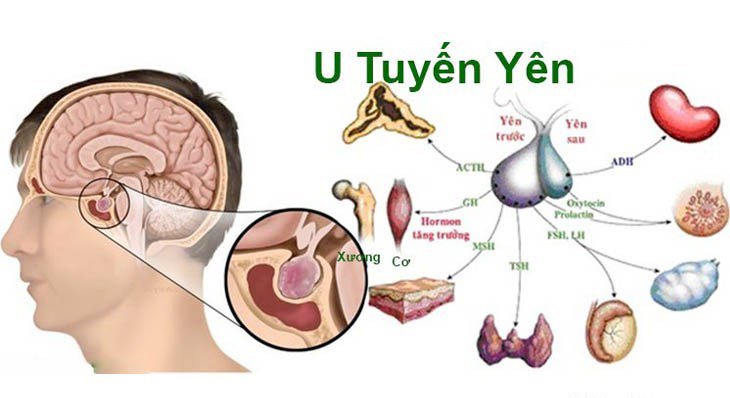 Nguyên nhân gây ra bệnh u tuyến yên là gì? Có phương pháp nào để điều trị hay không?