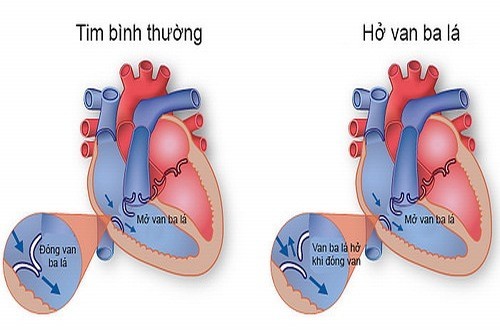 Nguyên nhân, triệu chứng và cách điều trị bệnh hở van tim 3 lá
