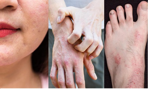Nhận biết các triệu chứng của bệnh viêm da cơ địa ở người lớn và cách điều trị
