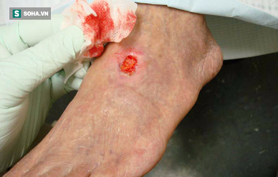 Nhiễm trùng huyết có phải là ung thư máu không?