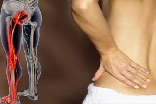 Những bài thuốc chữa đau thần kinh tọa hiệu quả nhất