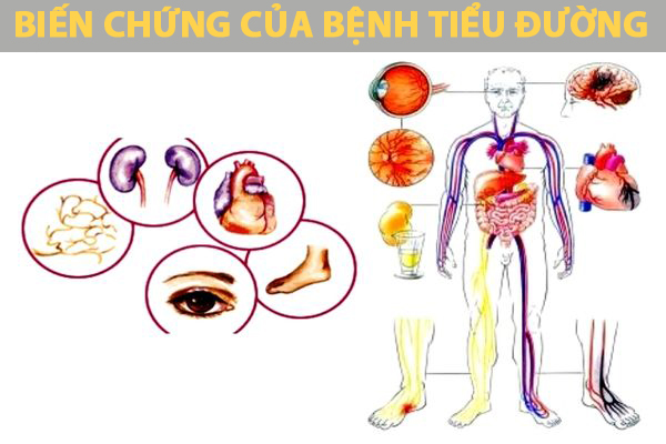 Những biến chứng nguy hiểm của bệnh tiểu đường mà chúng ta cần biết