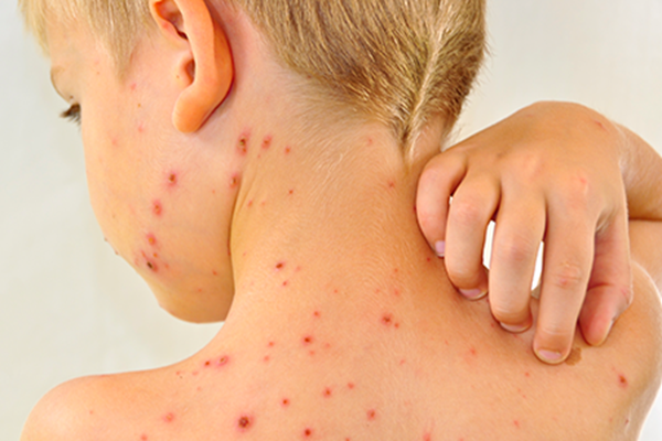 Những biểu hiện sốt xuất huyết ở trẻ mà bố mẹ cần phải biết