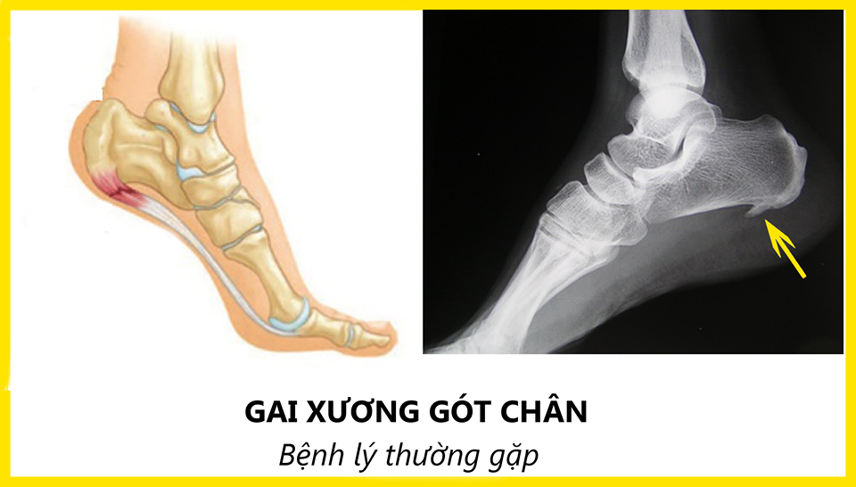 Những phương pháp chẩn đoán và điều trị bệnh gai xương