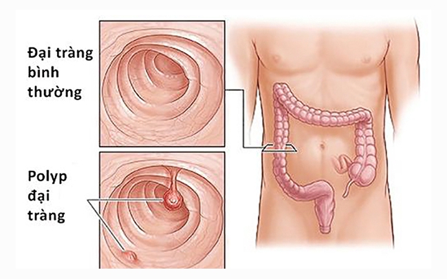 Những phương pháp nào dùng trong điều trị Polyp đại tràng?