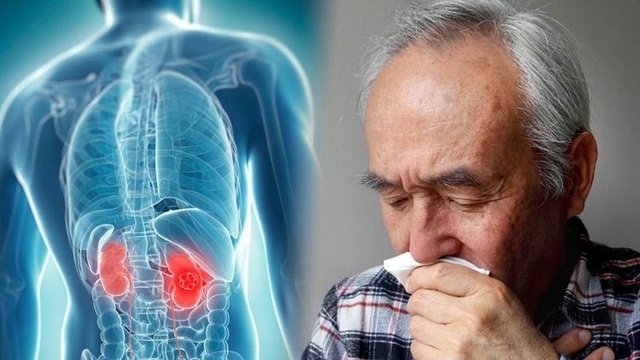 Những triệu chứng mắc ung thư thận và các phương pháp điều trị bệnh mà bạn cần biết