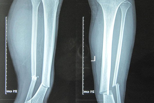 Phục hồi chức năng sau gãy xương cẳng chân như thế nào hiệu quả?