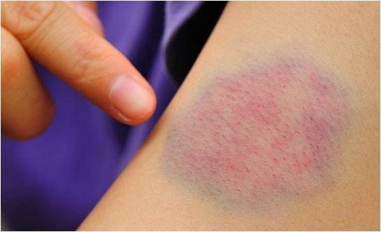 Phương pháp chẩn đoán và điều trị bệnh ung thư bạch cầu là gì?