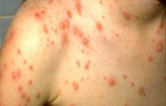 Rubella (bệnh sởi ở đức) – những thông tin đáng chú ý