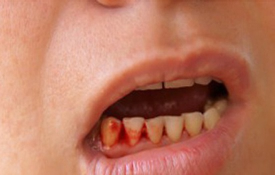 Sốt xuất huyết: nguyên nhân, triệu chứng và các điều trị