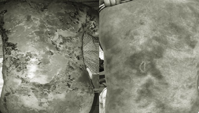 Tắm nước lá kết hợp với đi thầy cúng để chữa bệnh, người phụ nữ bị lột da toàn thân, bốc mùi hôi thối