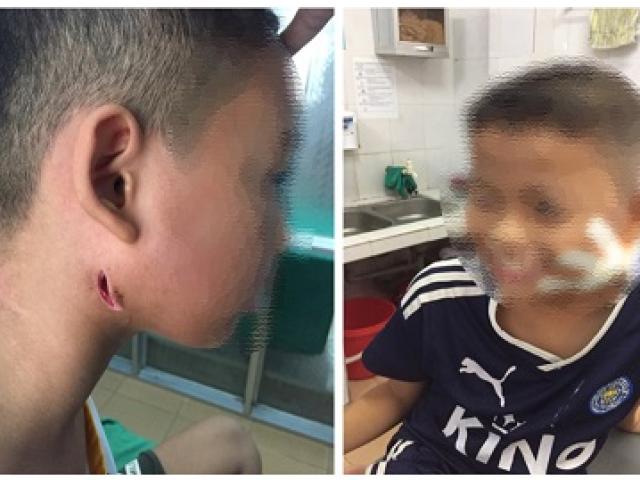 Thương tâm hai anh em tử vong do nhiễm vi khuẩn ăn mòn cơ thể Whitmore