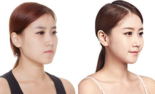 Tiêm Botox là gì? Ứng dụng tiêm Botox trong ngành thẩm mỹ như thế nào?