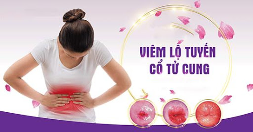 Tìm hiểu viêm lộ tuyến cổ tử cung là gì? Bệnh có gây nguy hiểm không?