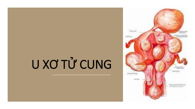 Tìm hiểu các phương pháp điều trị u xơ tử cung hiệu quả hiện nay