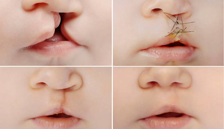 Tìm hiểu cách điều trị bệnh hở hàm ếch và biện pháp phòng tránh