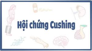 Tìm hiểu nguyên nhân gây ra hội chứng Cushing và các phương pháp điều trị