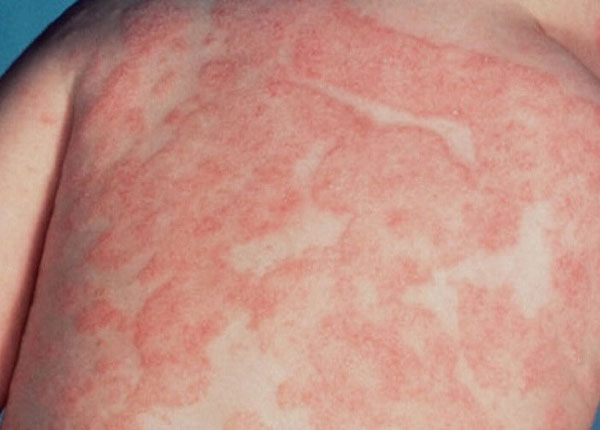 Tìm hiểu nguyên nhân và các phương pháp điều trị bệnh Lichen