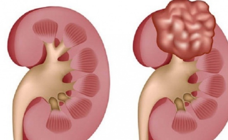 Tìm hiểu những thông tin về bệnh u nang thận