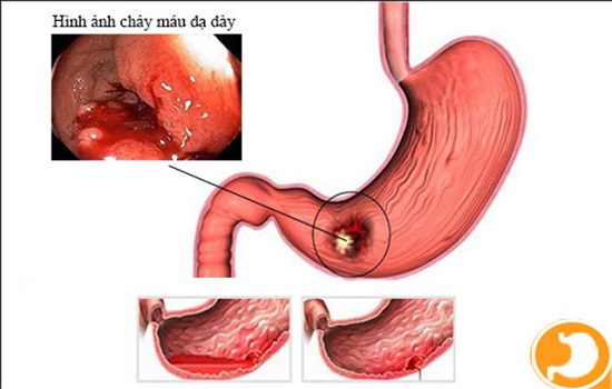 Tìm hiểu về công dụng của thuốc Ciaflam