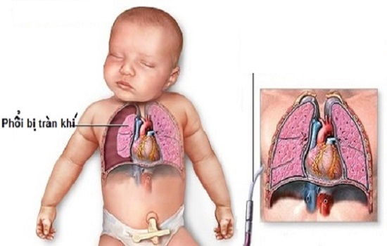 Tràn khí màng phổi: triệu chứng, nguyên nhân, điều trị, phòng tránh