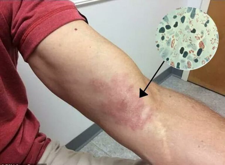 Triệu chứng của bệnh phong như thế nào? Có chữa khỏi được không?