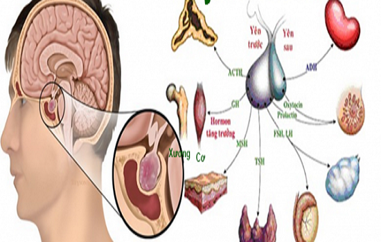 U tuyến yên do đâu và điều trị như thế nào?