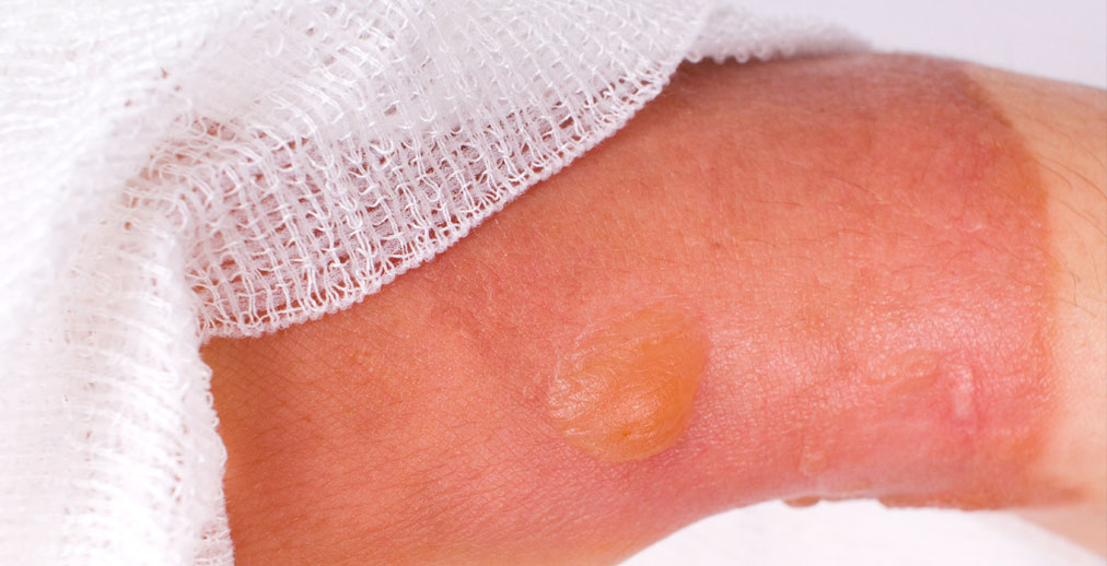 Vết bỏng bị nhiễm trùng có những dấu hiệu nhận biết nào?