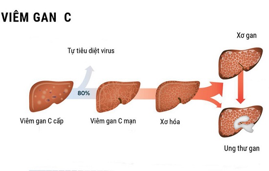 Viêm gan C: triệu chứng,nguyên nhân, cách điều trị
