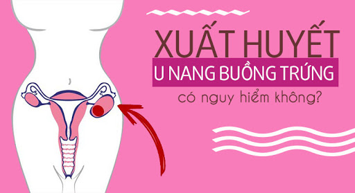 Xuất huyết u nang buồng trứng có nguy hiểm không?