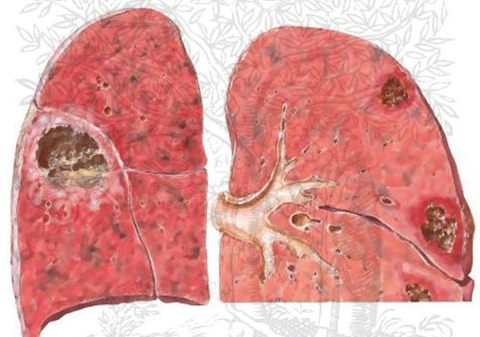 Bệnh phổi kẽ là bệnh gì?