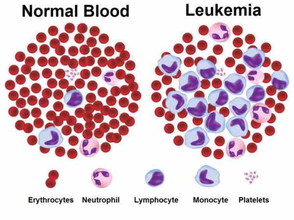 benh-leukemia