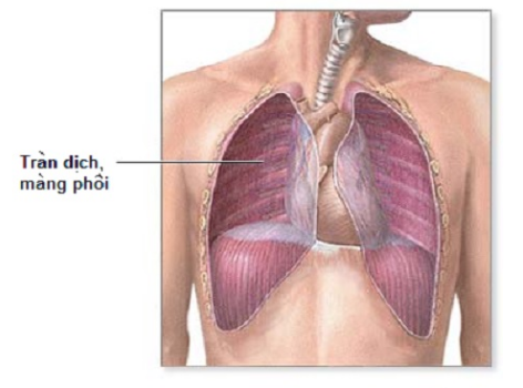 Bệnh phù phổi là bệnh gì