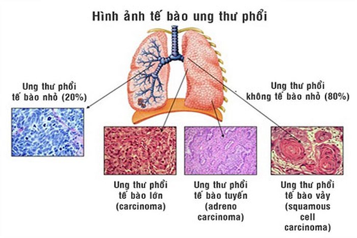 ung thư phổi 