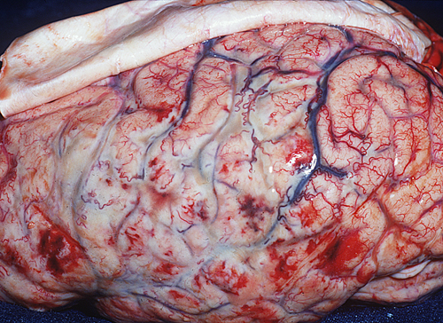 viêm màng não là bệnh gì?