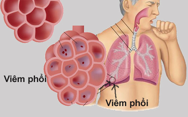 triệu chứng của bệnh viêm phổi