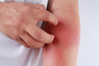 Các triệu chứng của viêm da tiếp xúc là gì?